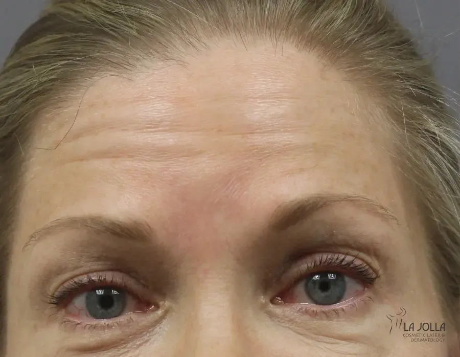 BOTOX & Wrinkle Relaxers