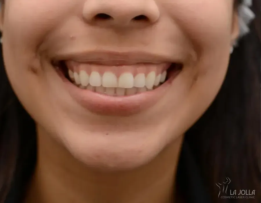 BOTOX & Wrinkle Relaxers