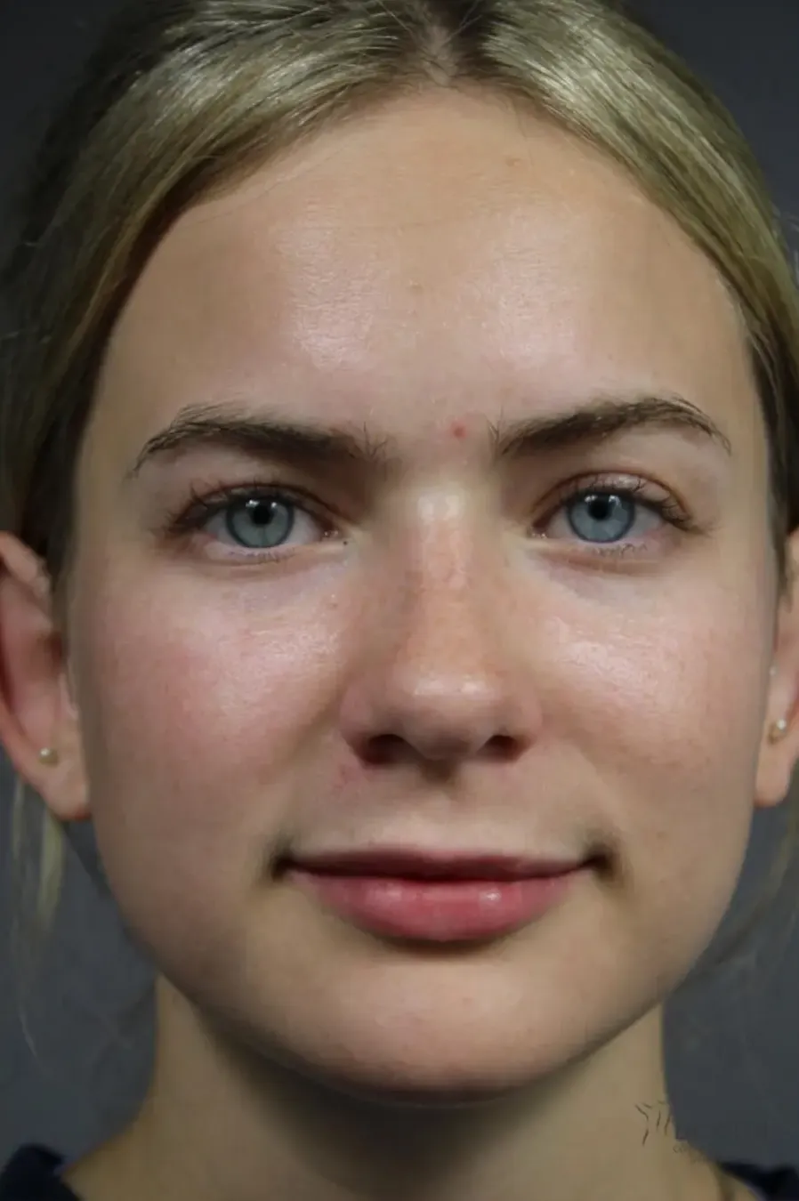 Dermal Fillers