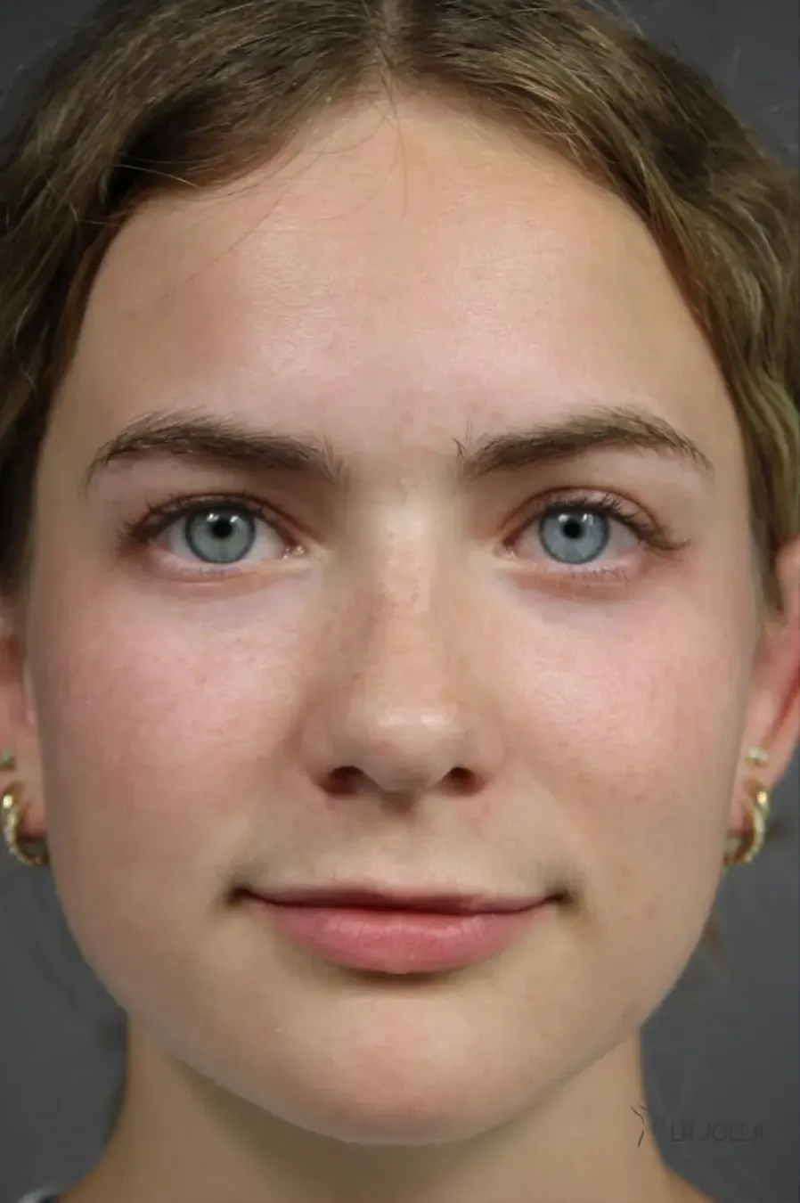 Dermal Fillers