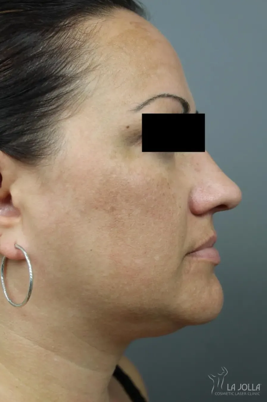 Kybella