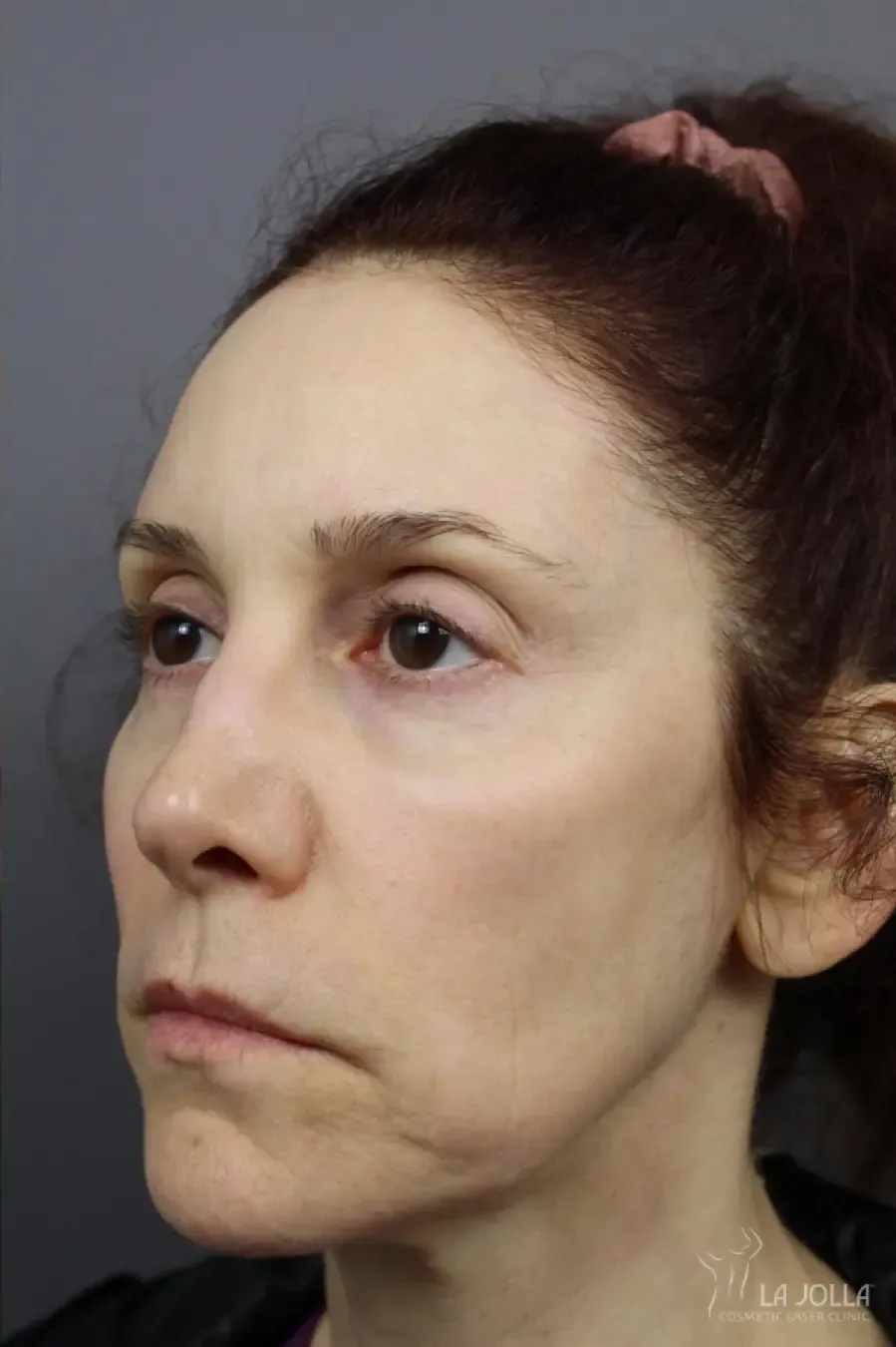 Liquid Facelift