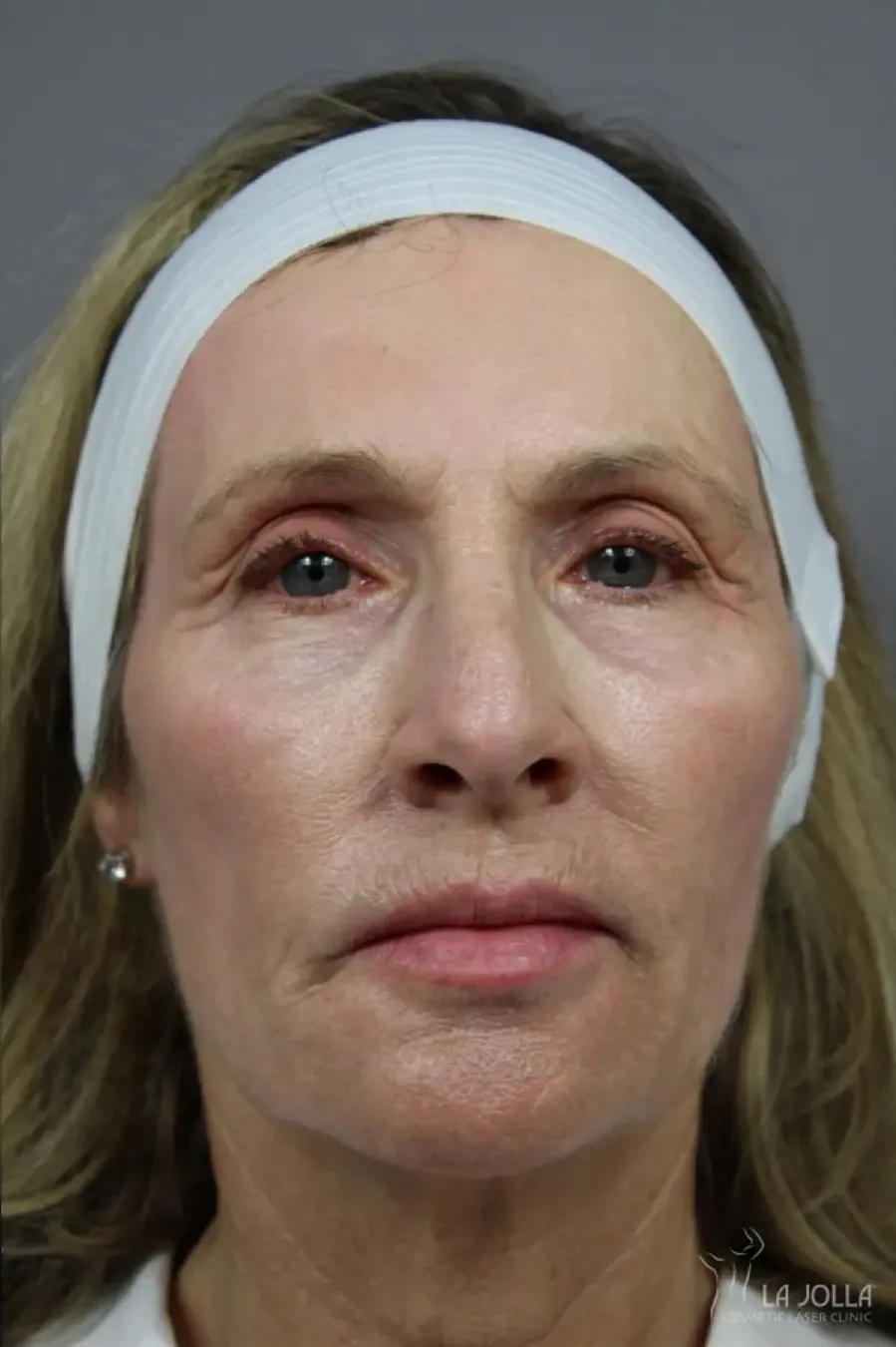 Liquid Facelift