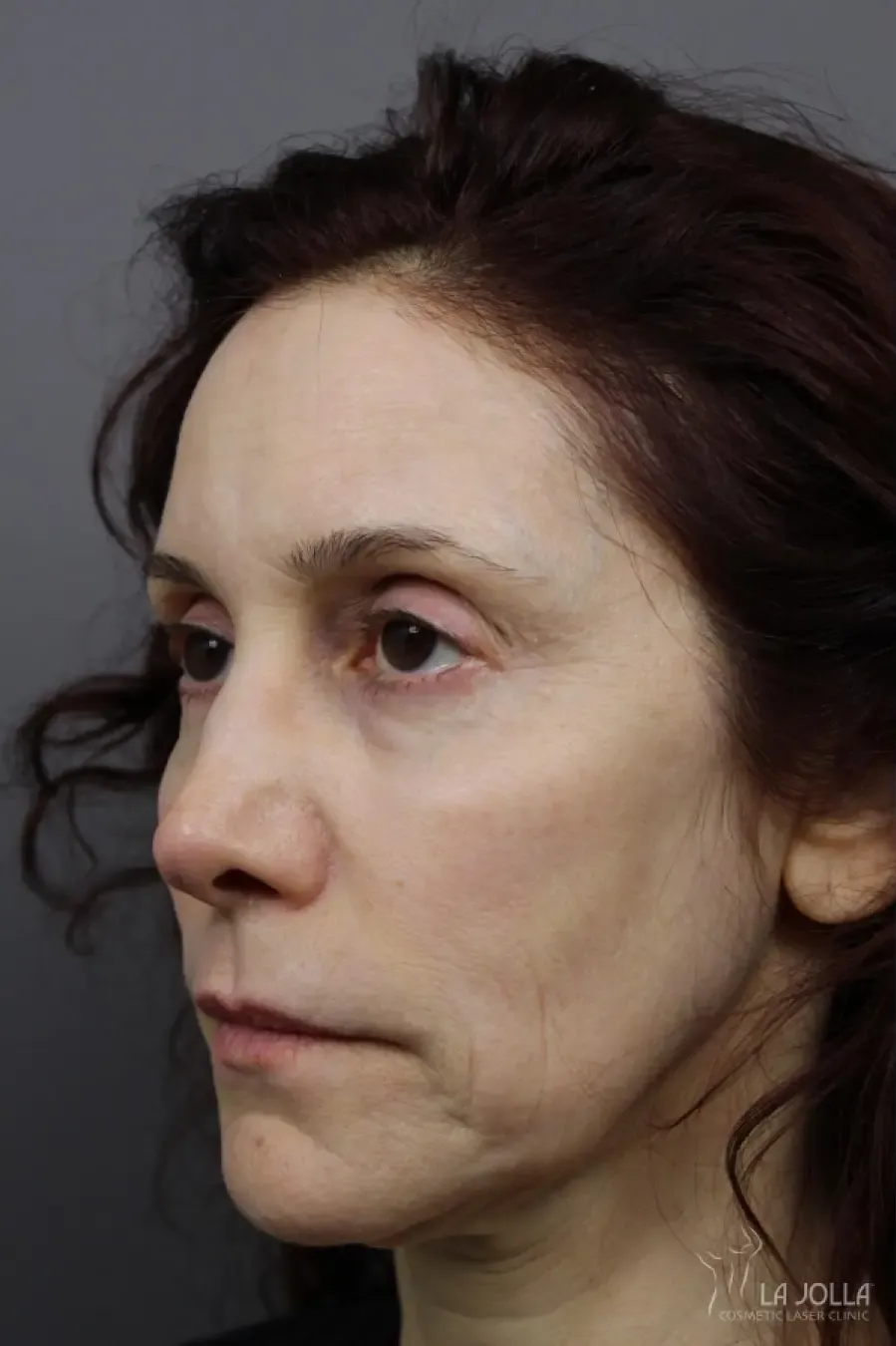 Liquid Facelift