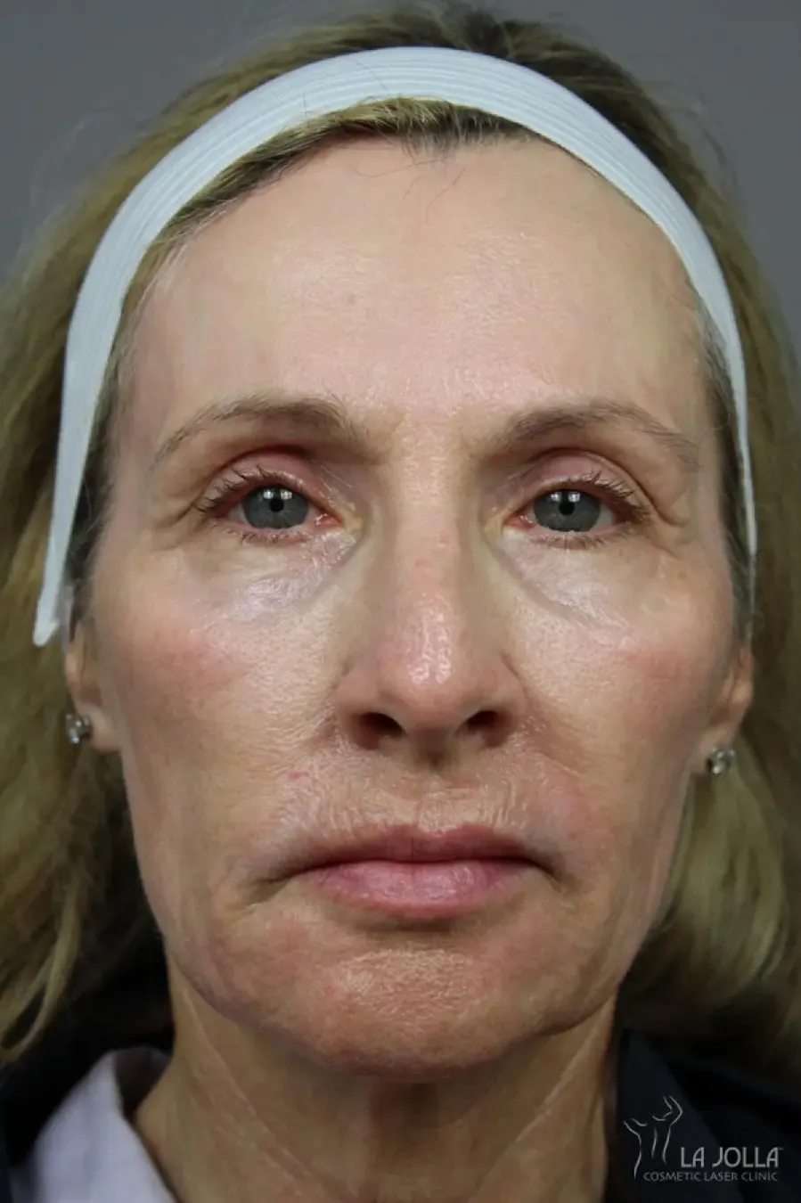 Liquid Facelift