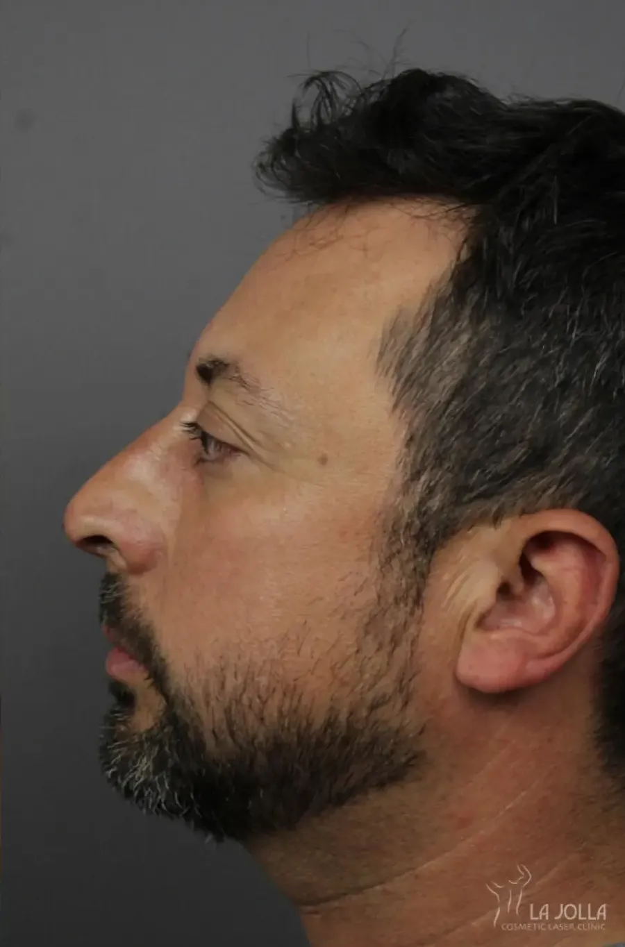 Non-Surgical Rhinoplasty