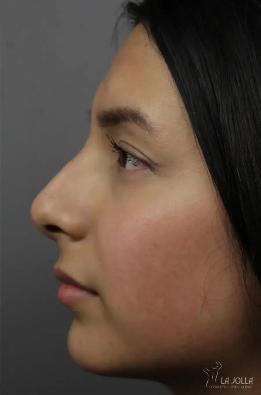 Non-Surgical Rhinoplasty