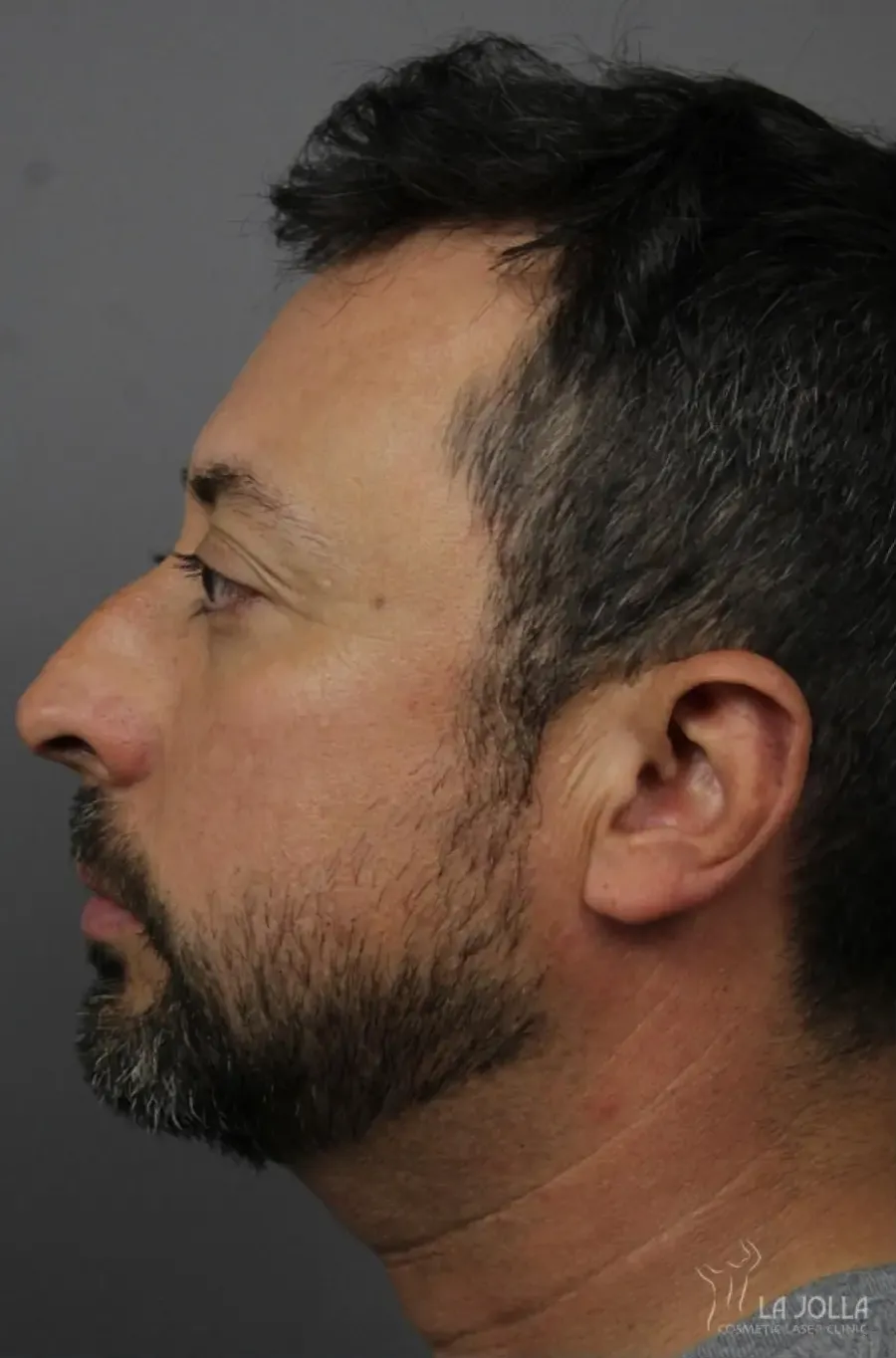 Non-Surgical Rhinoplasty