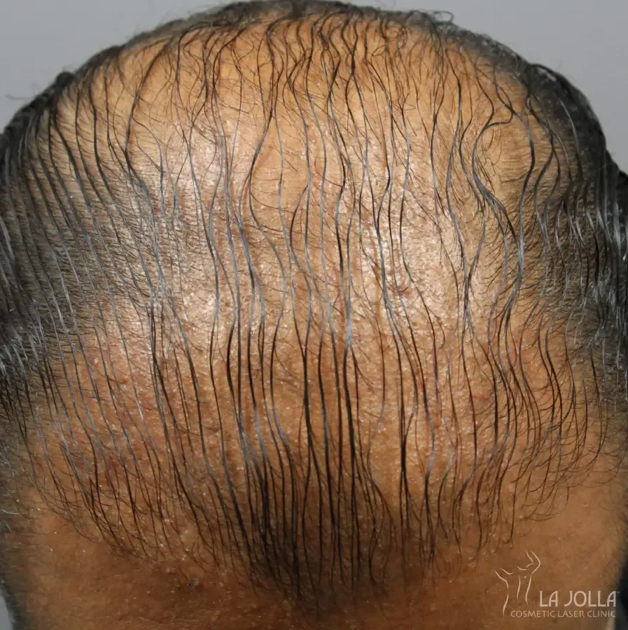 Regenerative Medicine