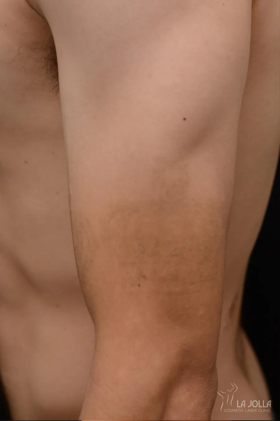 Laser Tattoo Removal