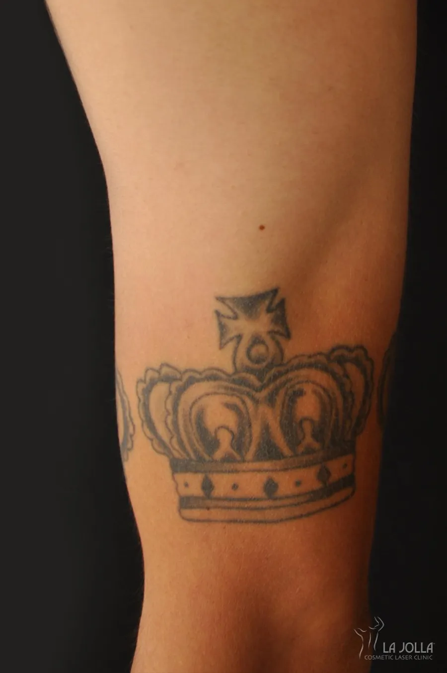 Laser Tattoo Removal