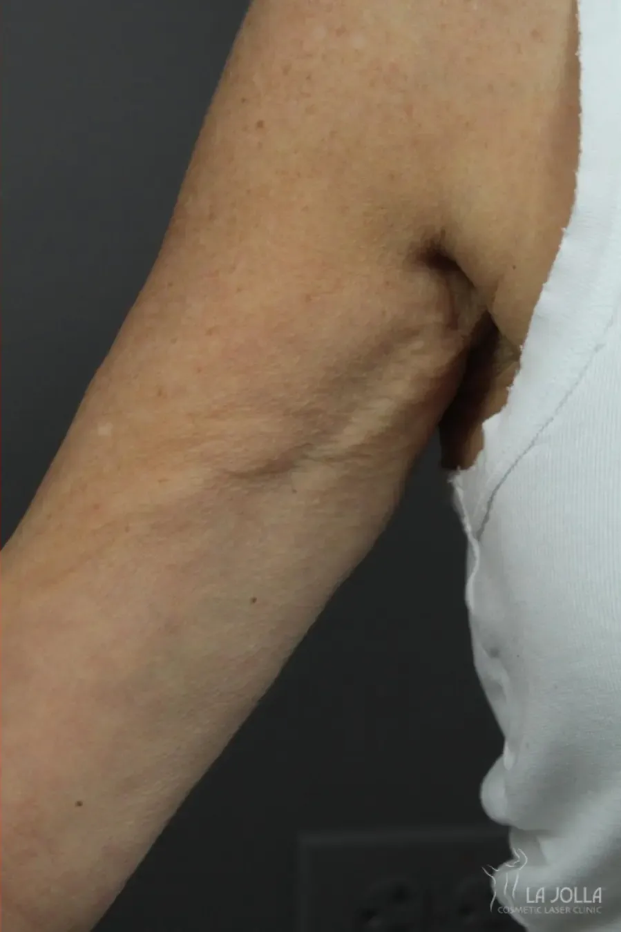 TightSculpting