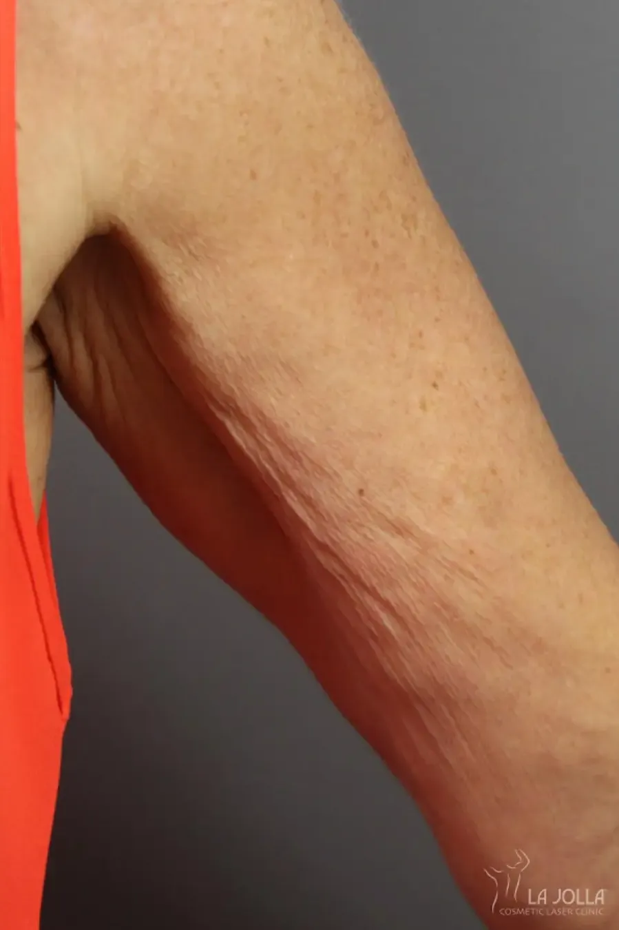 TightSculpting