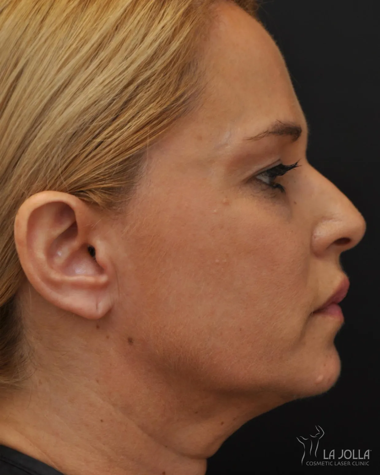 Ultherapy
