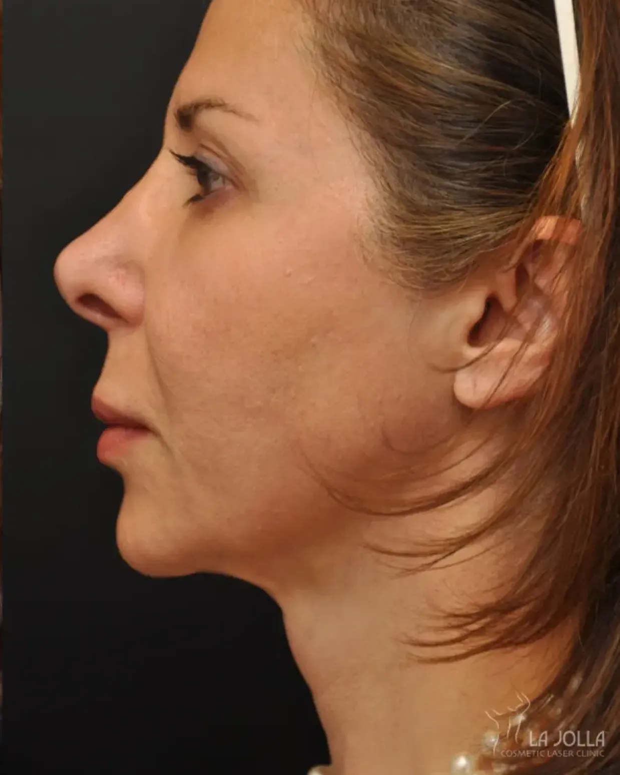Ultherapy