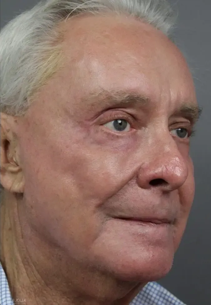 Ablative Laser Treatment