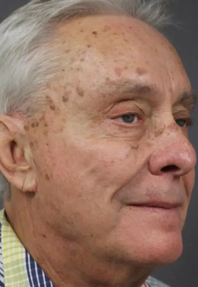 Ablative Laser Treatment