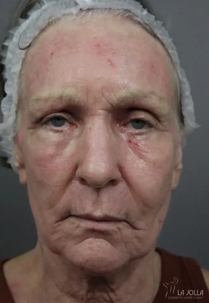 Ablative Laser Treatment