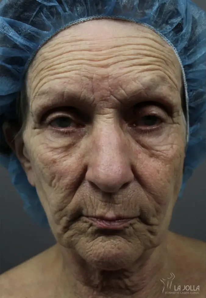 Ablative Laser Treatment