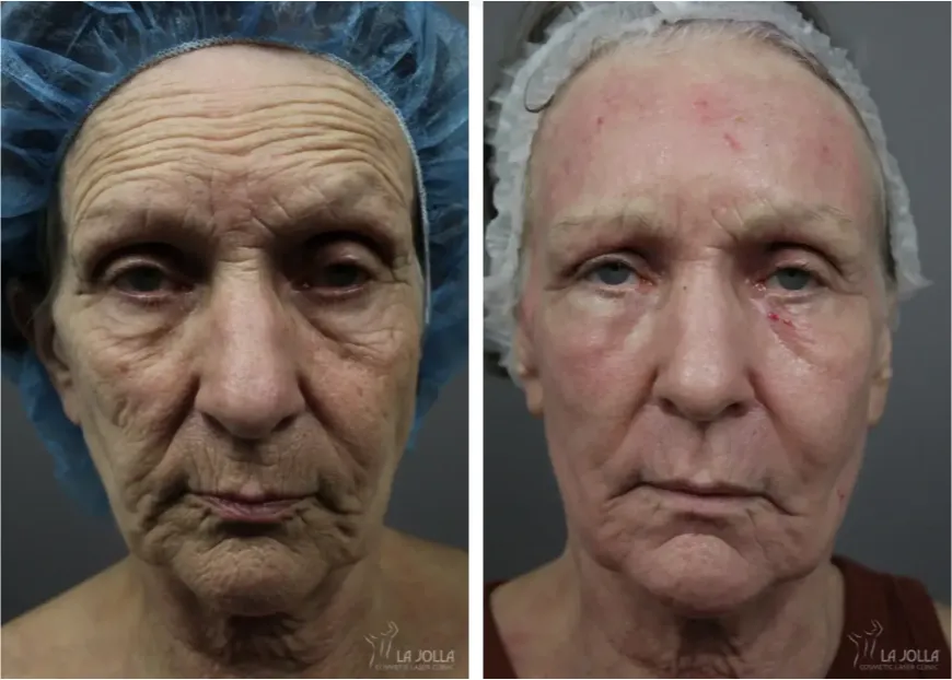 Ablative Laser Treatment