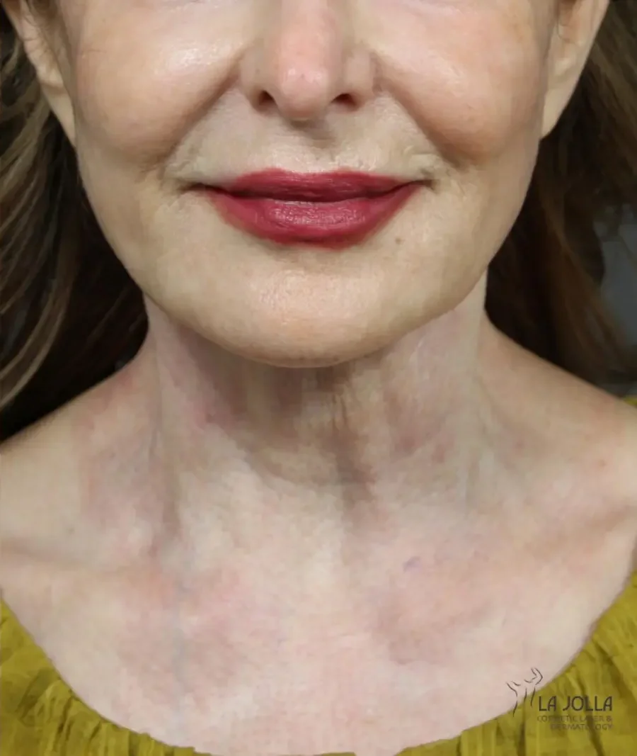 Laser Coring (Poke A Dot Lift™)