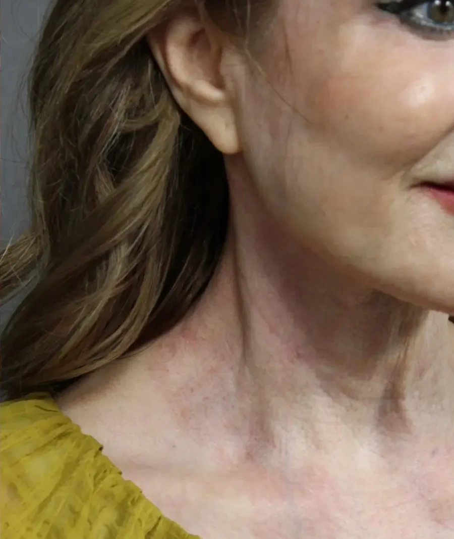 Laser Coring (Poke A Dot Lift™)