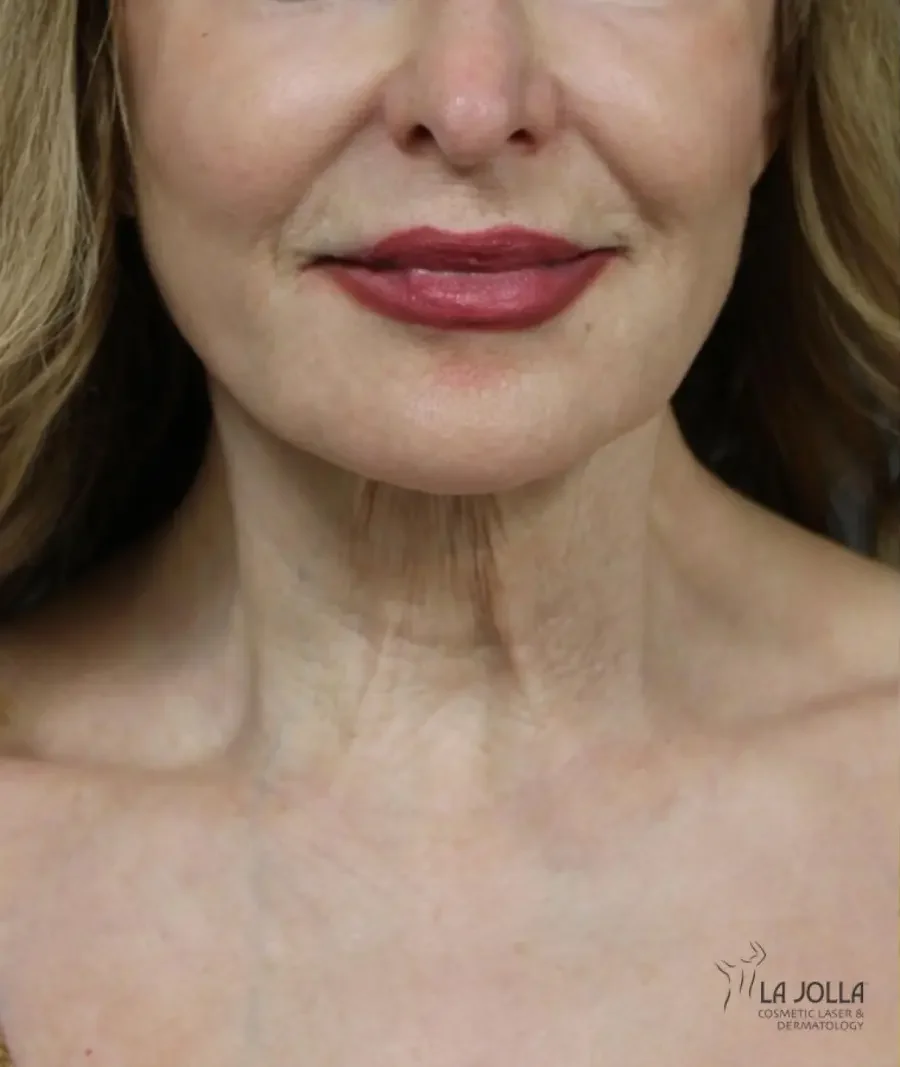 Laser Coring (Poke A Dot Lift™)