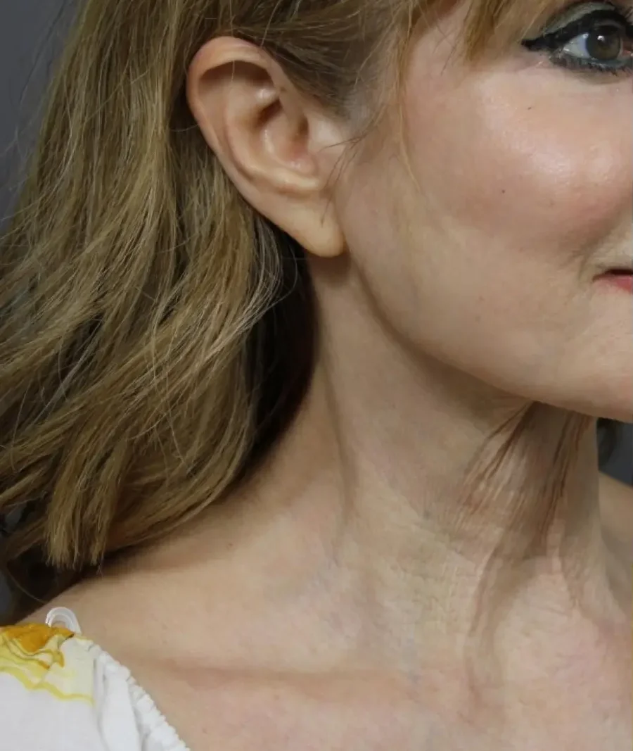 Laser Coring (Poke A Dot Lift™)