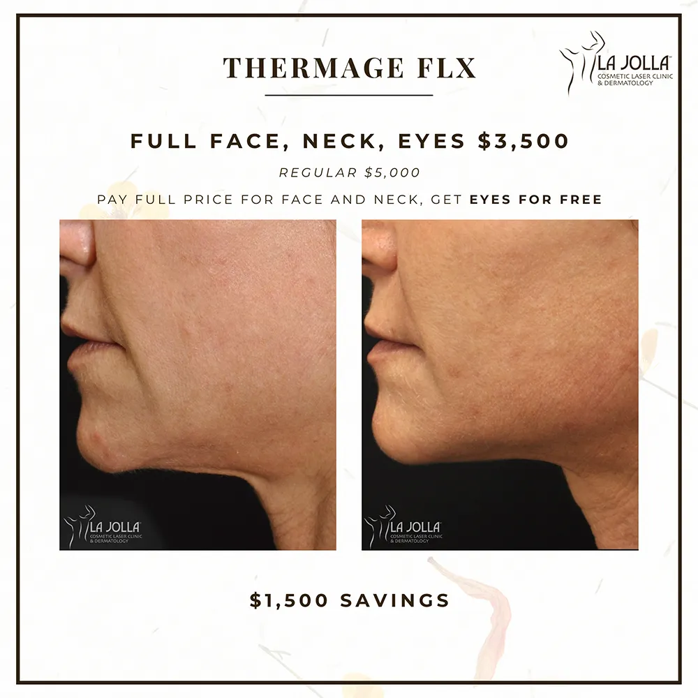 special-april-thermage