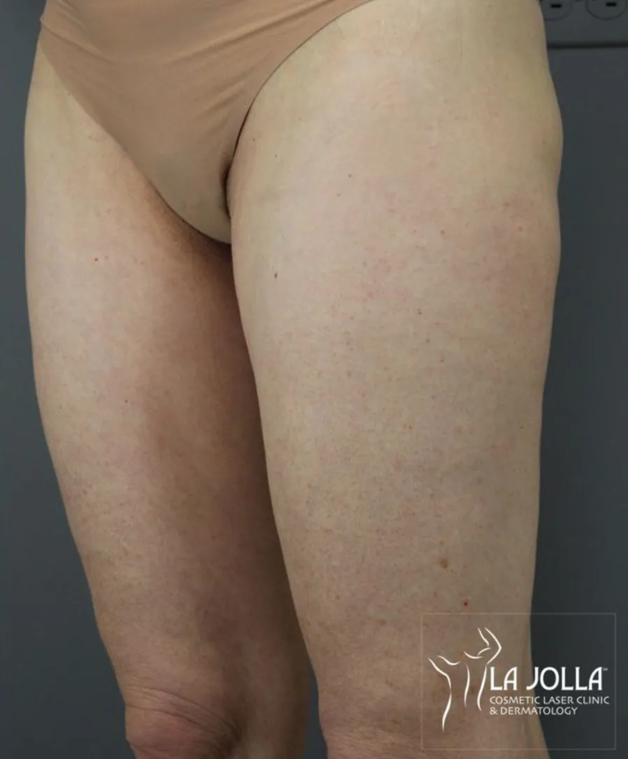 Thermage FLX