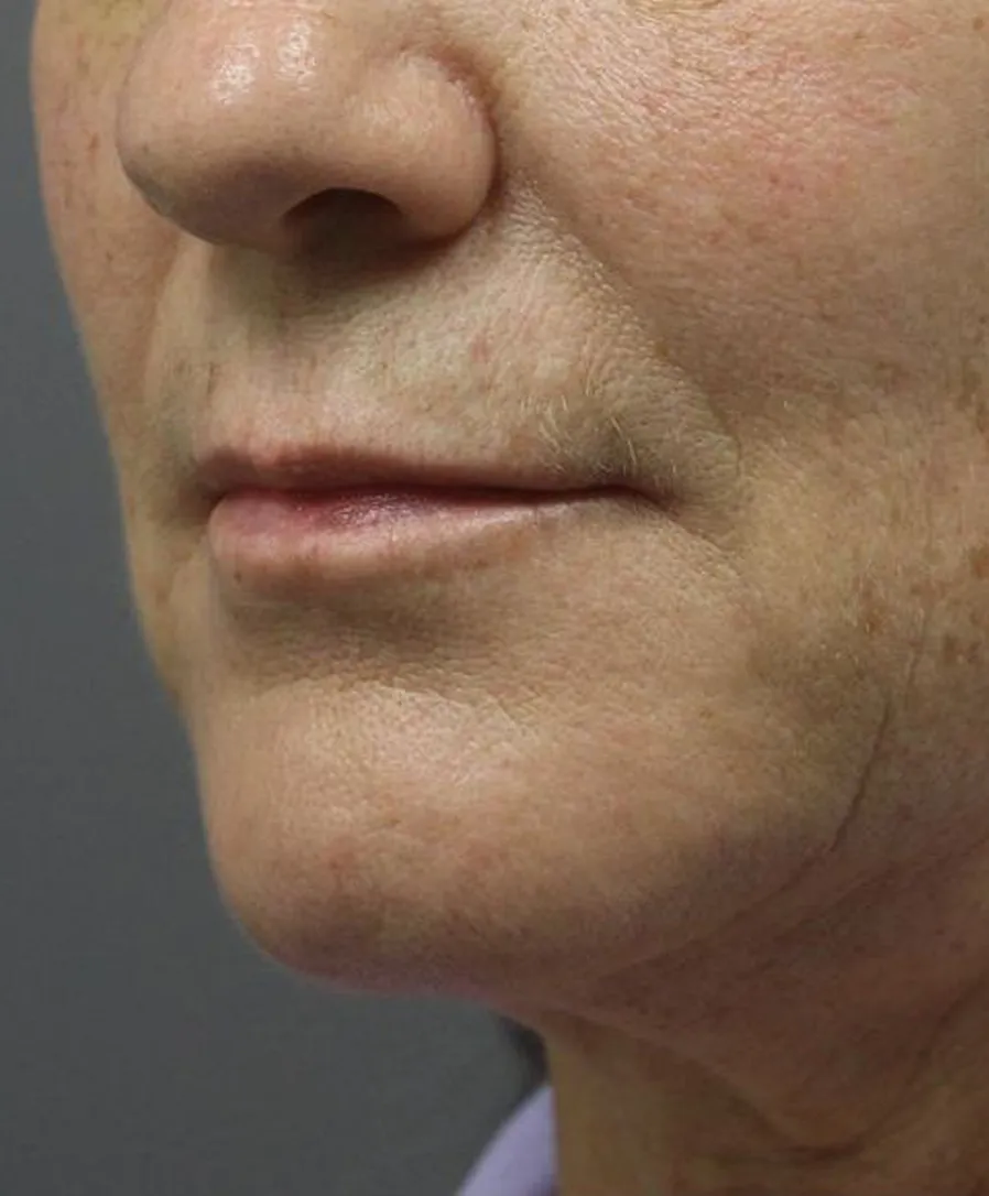 Ultherapy Prime