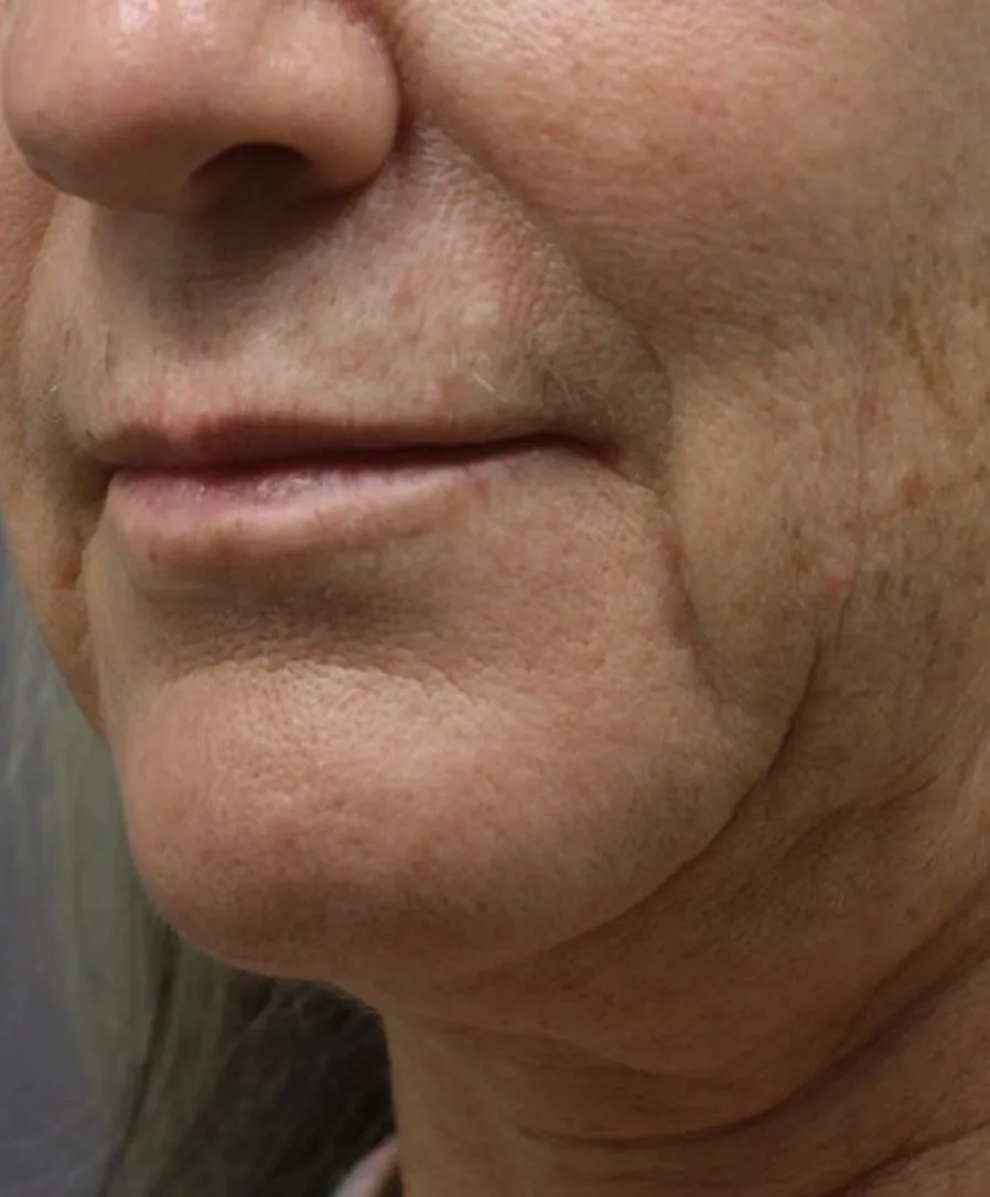 Ultherapy Prime
