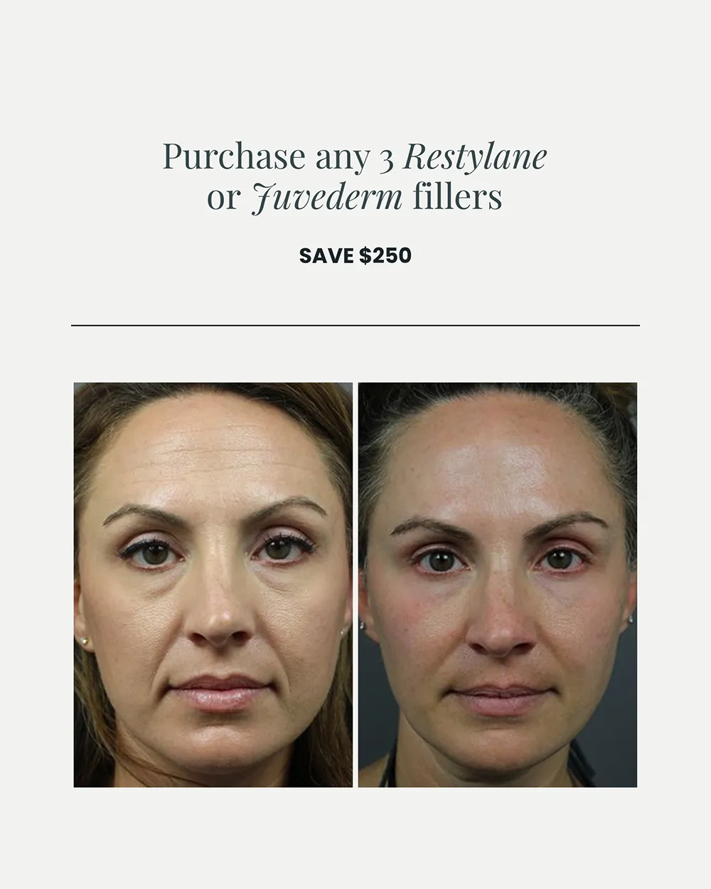 JULY PROMO_Dermal Fillers