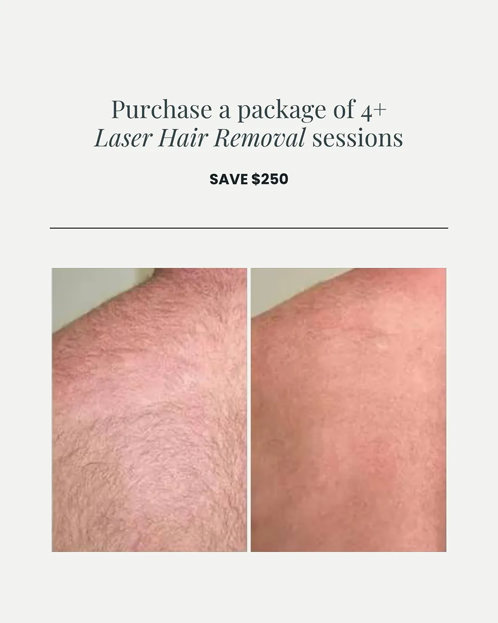 JULY PROMO_Laser Hair Removal