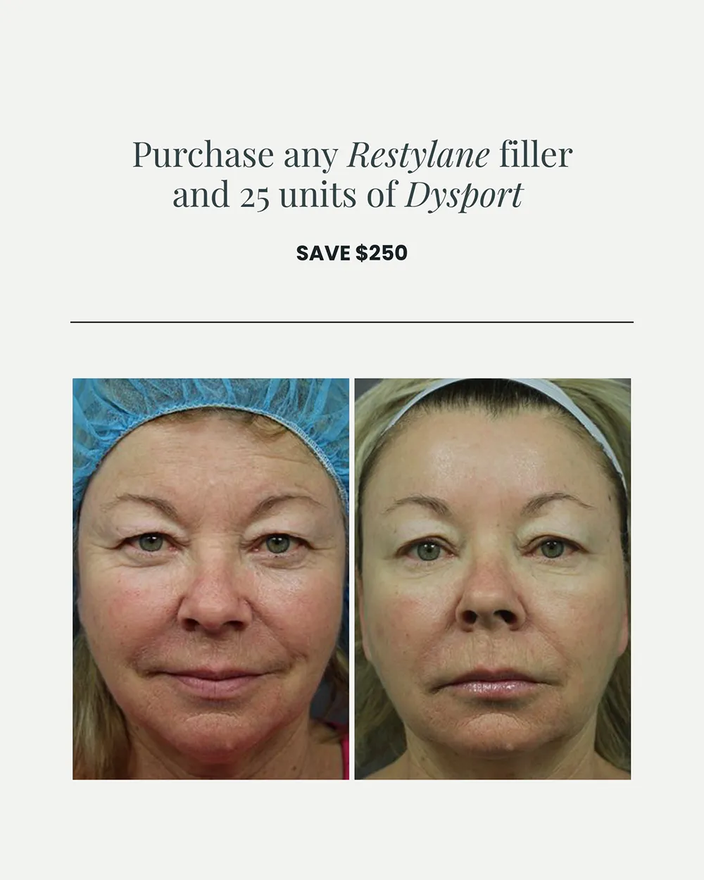 JULY PROMO_Restylane & Dysport