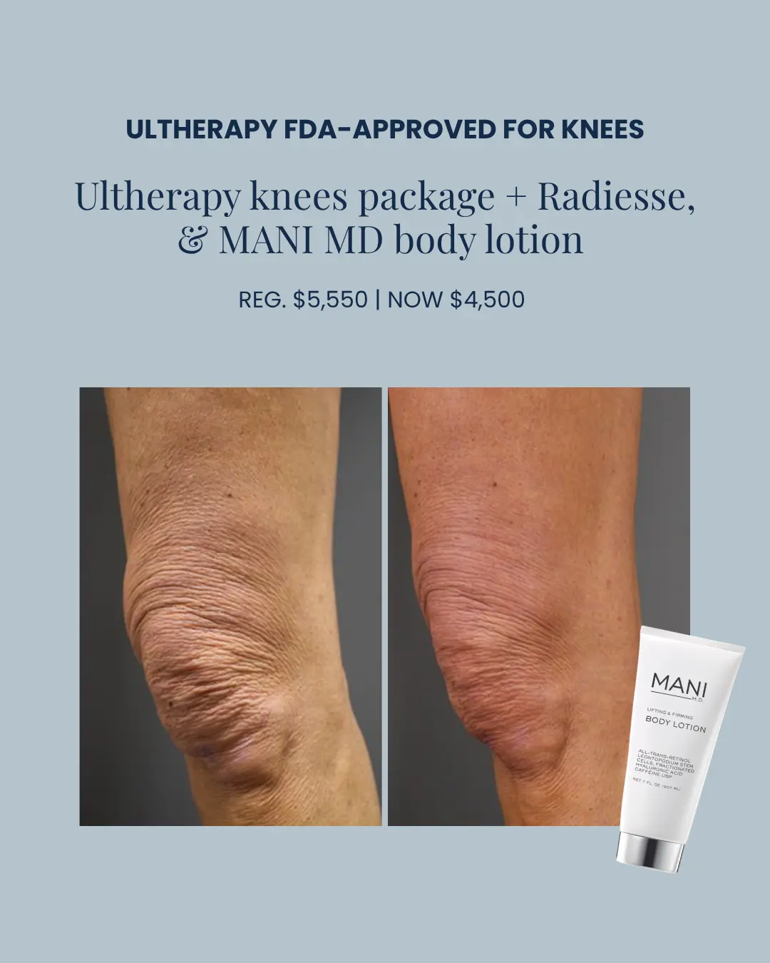 Ultherapy Package